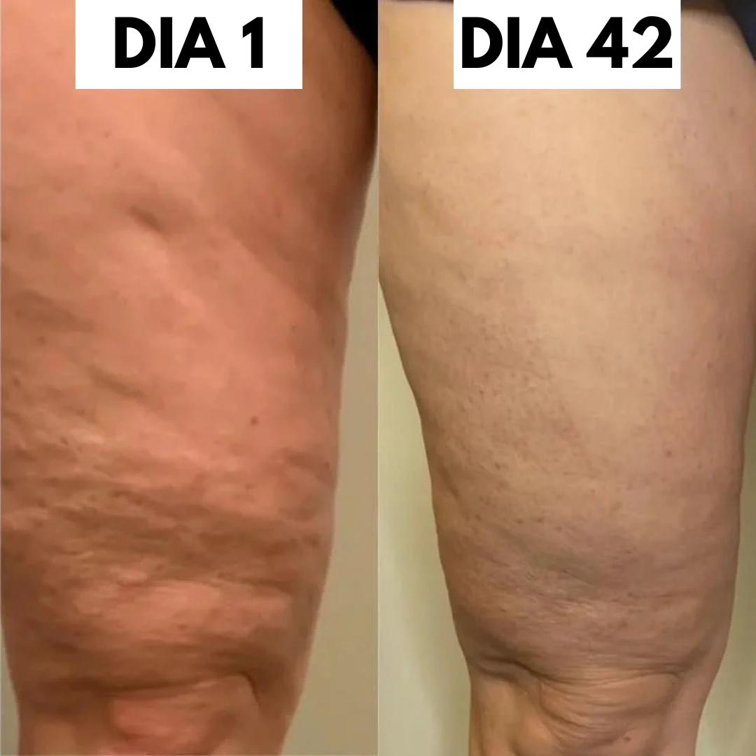 Kit Anticelulítico REVITALIF™